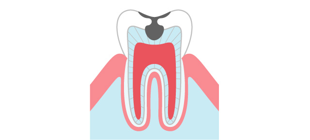 C1~C2の虫歯