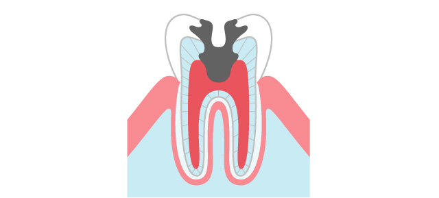 C3の虫歯