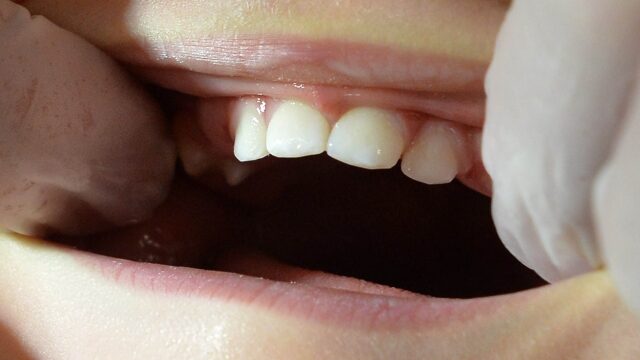 歯医者の フッ素 塗布はいつから始めるべき?
